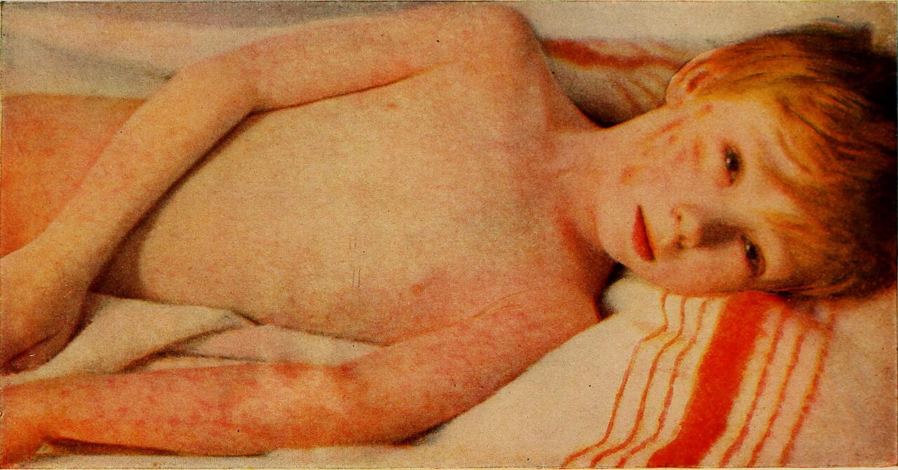 Historical medical illustration from 1922 showing a measles patient with characteristic facial expression and eyes, from Medical Diagnosis for the Student and Practitioner / The Library of Congress
