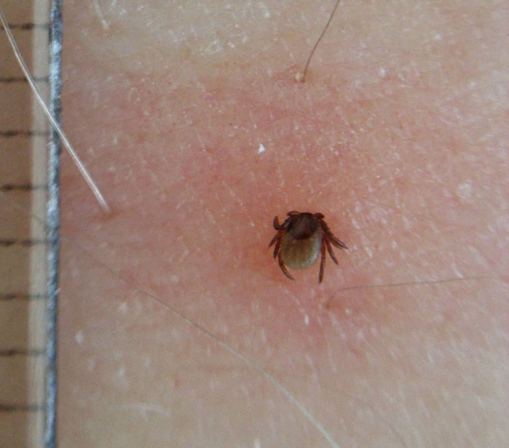 Close-up of a tick feeding from a person's leg with a millimeter ruler scale / Wikimedia Commons