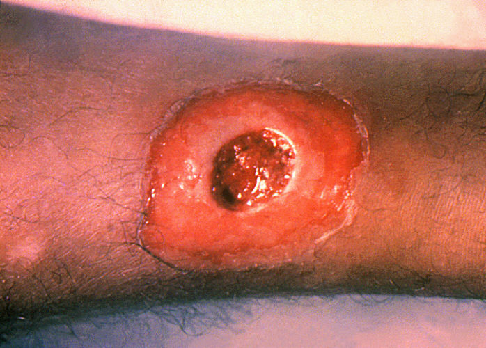 A diphtheria skin lesion on the leg showing an open wound from Corynebacterium diphtheriae skin infection / CDC Public Health Image Library